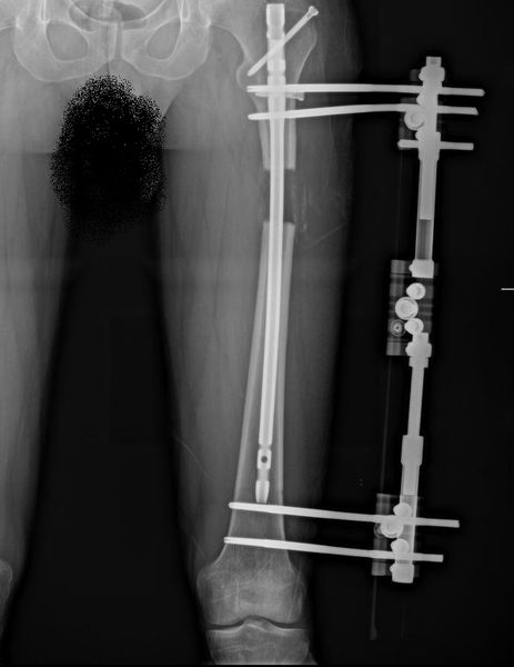 Lon Femur Surgery 167 cm start height ( My doc is professor Halil İbrahim Balci)