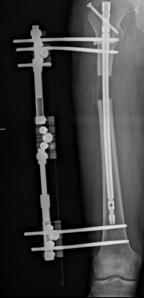 Lon Femur Surgery 167 cm start height ( My doc is professor Halil İbrahim Balci)